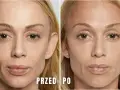 Modelowanie żuchwy przed i po. Porównanie twarzy kobiety przed i po zabiegu, ukazujące subtelne zmiany w linii żuchwy.