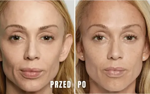 Modelowanie żuchwy przed i po. Porównanie twarzy kobiety przed i po zabiegu, ukazujące subtelne zmiany w linii żuchwy.