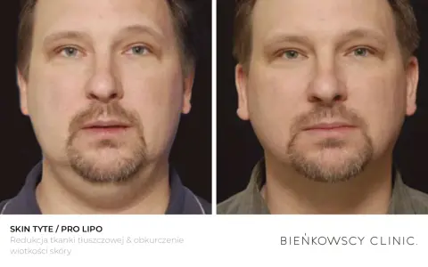 Przed i po zabiegu lipolizy podbródka. Widoczna redukcja tkanki tłuszczowej i poprawa napięcia skóry.
