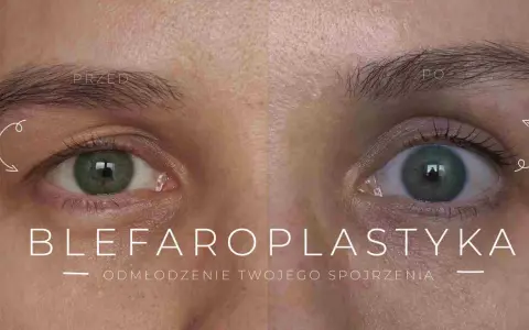 Przed i po zabiegu blefaroplastyki. Widoczna poprawa wyglądu powieki, odmłodzenie spojrzenia.
