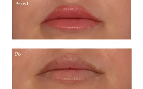 Przed i po zabiegu usuwania kresek permanentnych z ust. Widoczna różnica w odcieniu i konturze warg.