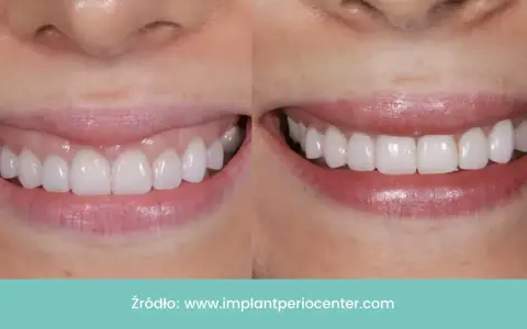 Uśmiech przed i po: zredukowany gummy smile, odsłonięte piękne, białe zęby.