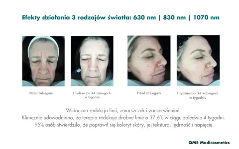 Przed i po terapii światłem LED w domu. Zmniejszenie zmarszczek i zaczerwienień. Poprawa kolorytu, tekstury i jędrności skóry.