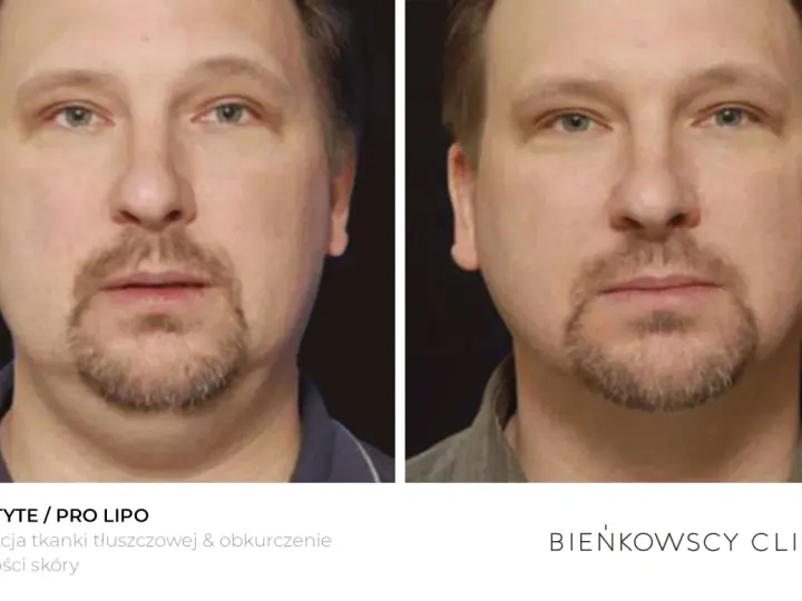 Przed i po zabiegu lipolizy podbródka. Widoczna redukcja tkanki tłuszczowej i poprawa napięcia skóry.