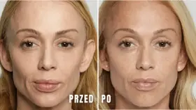 Modelowanie żuchwy przed i po. Porównanie twarzy kobiety przed i po zabiegu, ukazujące subtelne zmiany w linii żuchwy.