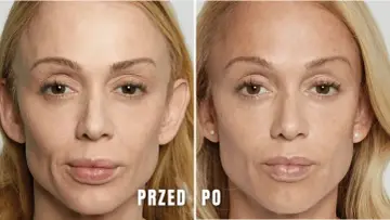 Modelowanie żuchwy przed i po. Porównanie twarzy kobiety przed i po zabiegu, ukazujące subtelne zmiany w linii żuchwy.