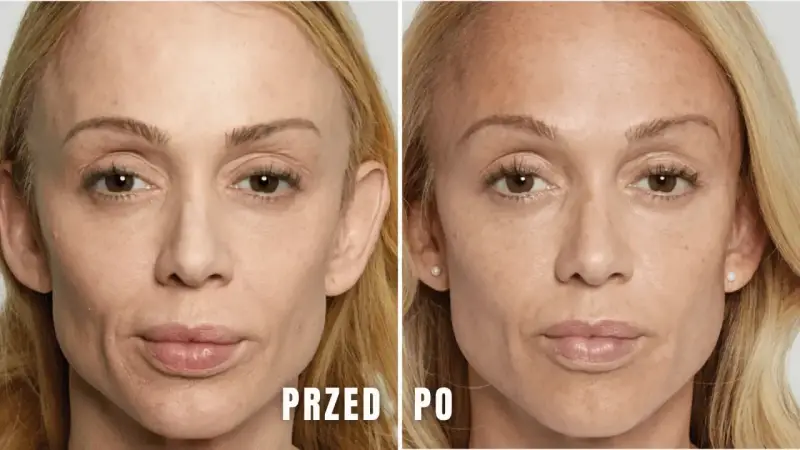 Modelowanie żuchwy przed i po. Porównanie twarzy kobiety przed i po zabiegu, ukazujące subtelne zmiany w linii żuchwy.